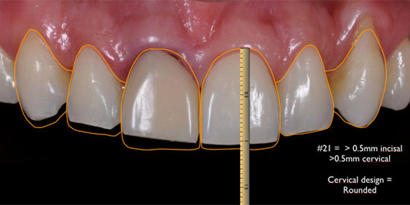 Digital Smile Design