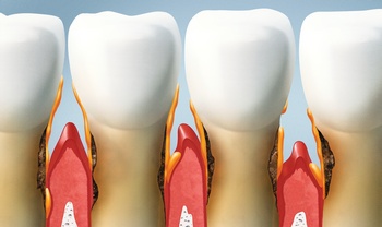 treat your teeth, periodontal