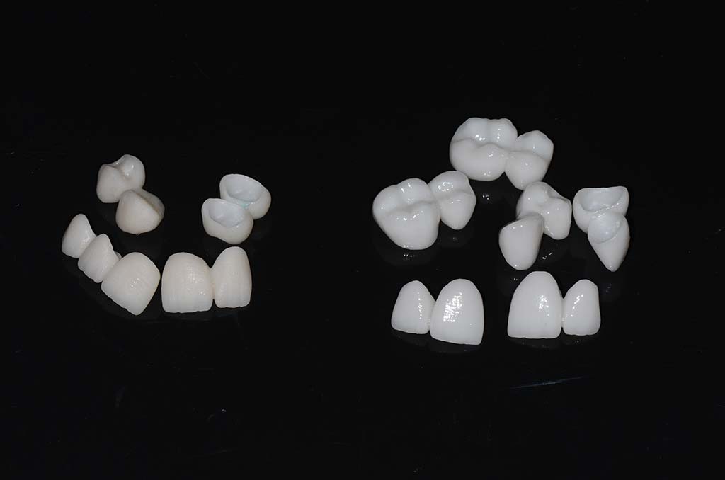 Proba-keramike-VS-gotovi-zubi