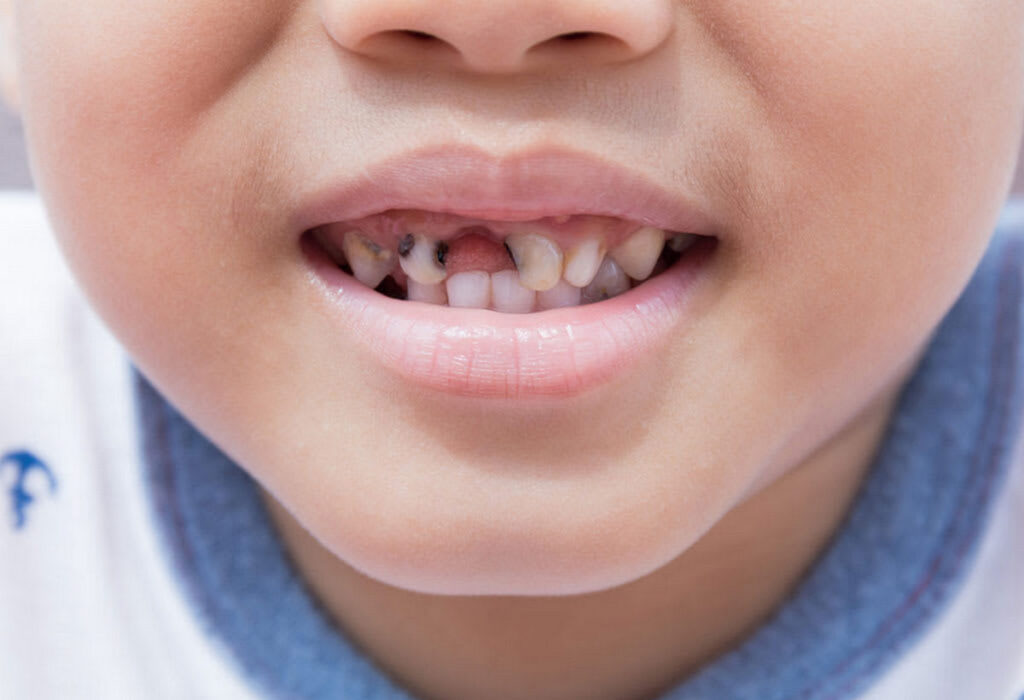 pokvareni zubi kod dece