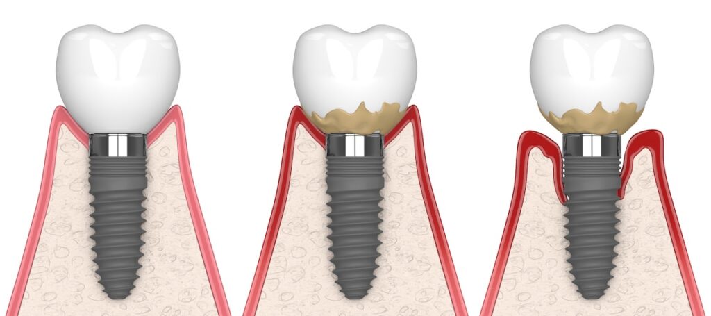 peri implantitis faze